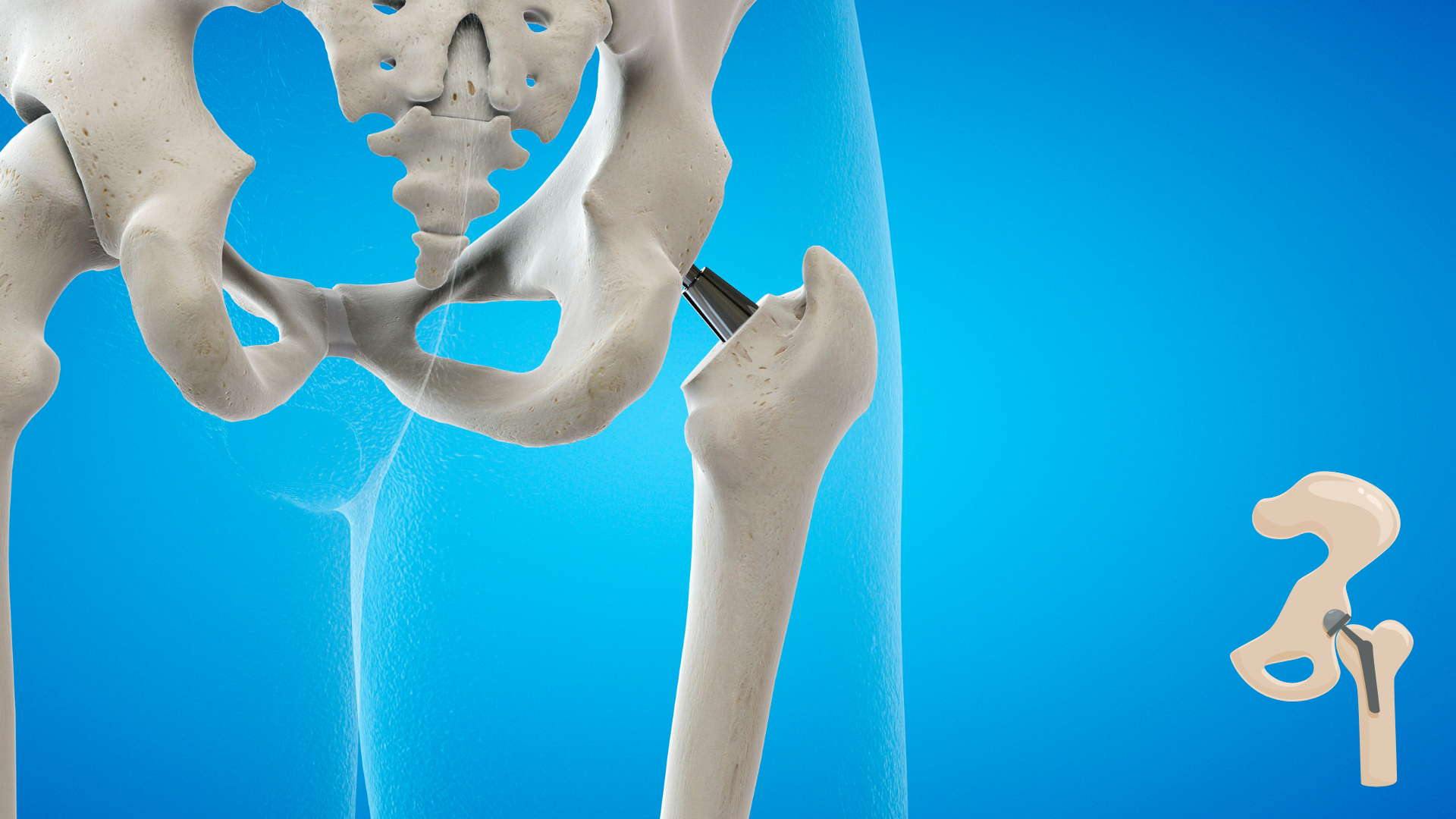 Hip Replacement Surgery Success Rate